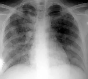 急性肺水肿的诊断及处理策略之干货
