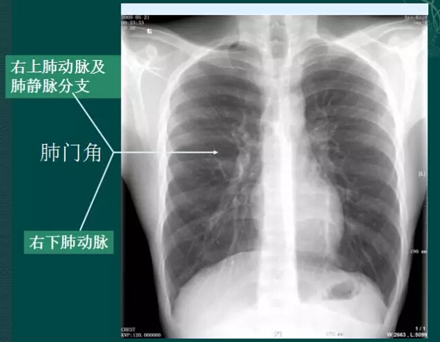 看完此文,终于学会看胸片了! 健康头条 移动版