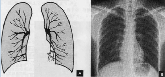2.肺纹理 肺纹理为自肺门向肺野呈放射