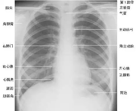 看完此文,终于学会看胸片了! 健康头条 移动版