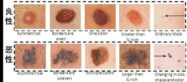 卢丙仑教授:良性,恶性痣的区分与治疗