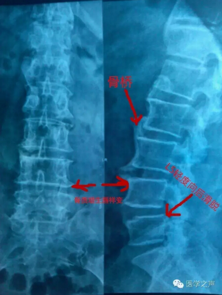 考试科研 > 每天学看一张x线片(第44期)    检查方法:腰椎正侧位片