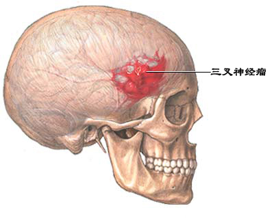 三叉神经痛最典型的三种病因