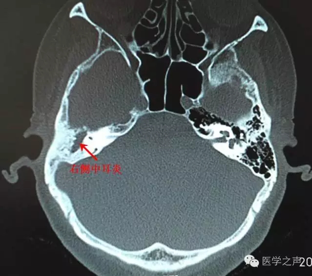 中耳乳突炎主要ct表现