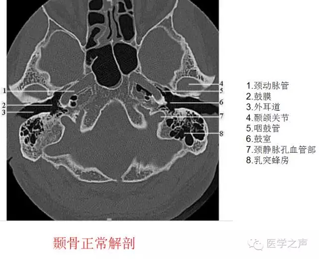 中耳乳突炎主要ct表现