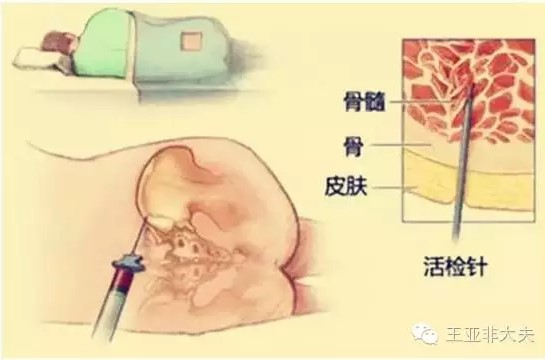 是否会留下严重的后遗症?有的人甚至会联想到骨穿会不会引起半