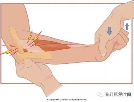 外上髁是前臂伸肌总腱附着的部位.