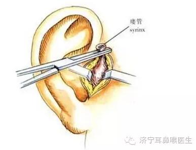 先天性耳前瘘管