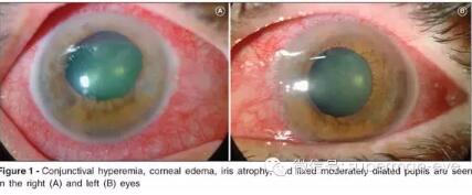 【表层巩膜炎】超人还是要强调,不是所有眼红都是感染或过敏,不要