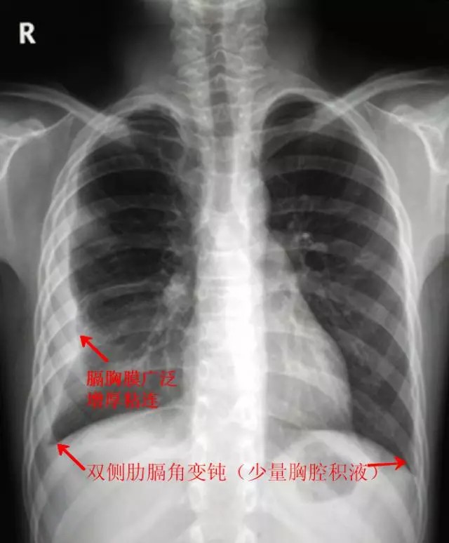 61期)    影像表现:   右侧中上胸广泛胸膜增厚粘连,双侧肋膈角稍变钝