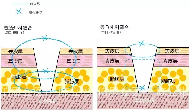 图说"减张精细缝合"