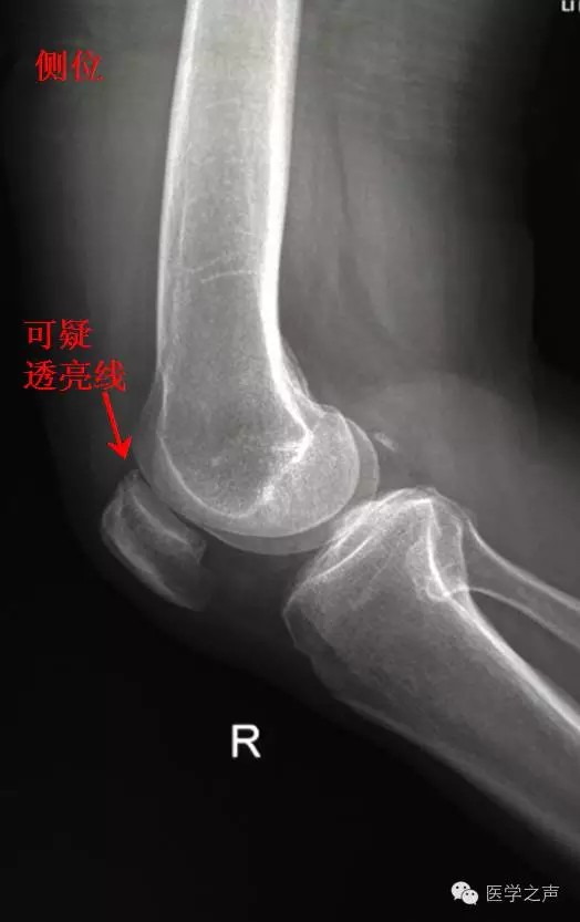 每天学看一张x线片(72期)