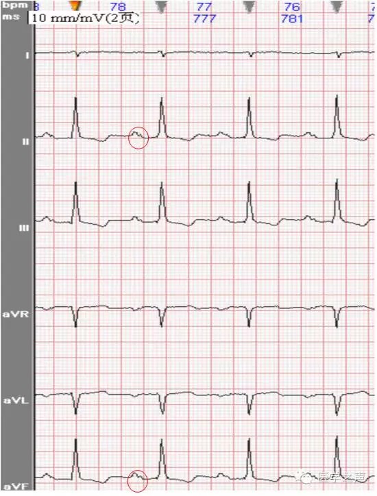 13s,电压正常在ii,iii,avf,v2-v6导联呈典型m型p波(双峰型),峰间距≈0
