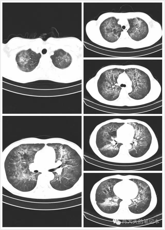 国庆病例:年轻患者,胸片酷似肺水肿(1)