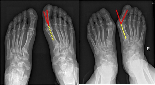 左图为正常人,右图为踇外翻,红箭所示的角度加大,也就是踇趾往外翻