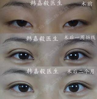 扇形双眼皮 眼头位置的重睑线和睫毛根部线是重合的;分开来,就