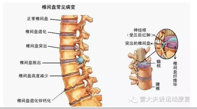 科普|腰椎间盘突出,治不治?