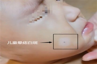 儿童晕痣白斑图片