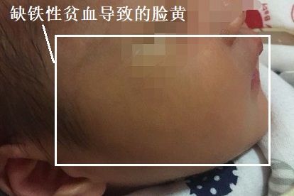 缺铁性贫血导致两岁宝宝脸黄