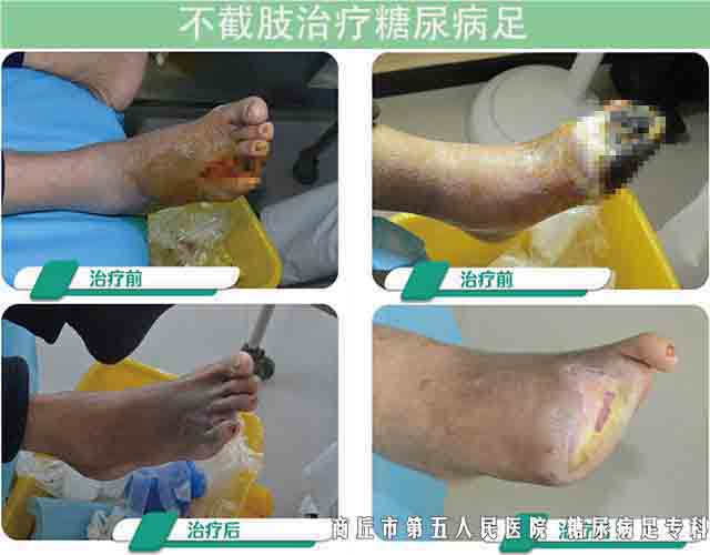 糖尿病足腳發黑了能不能保守治療康復