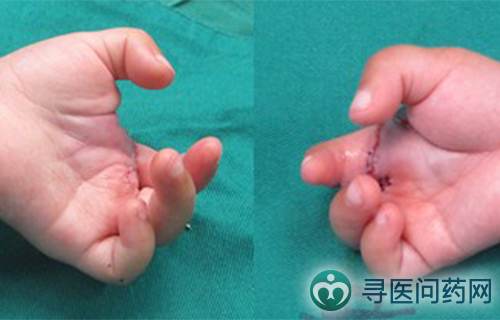 32个赞|6小时手术 患儿"畸形小爪"变小手
