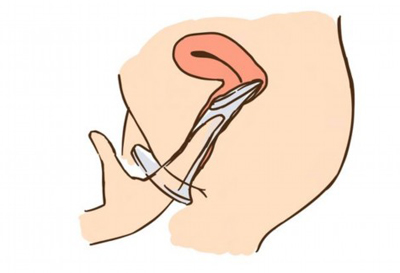 帶你瞭解女性避孕套的相關知識
