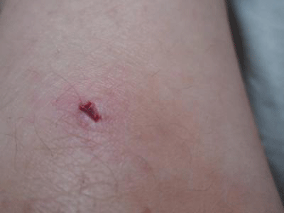 蜱虫咬狗后的伤口图图片