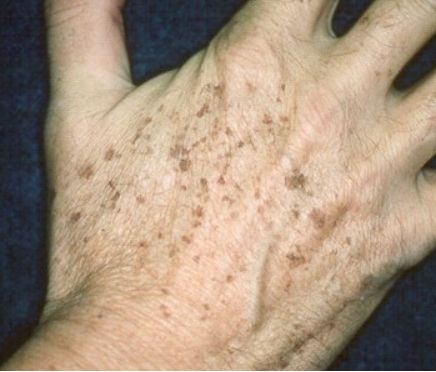 小心:皮肤癌更像是老年斑