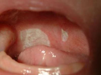 婴儿口腔炎的症状图片图片