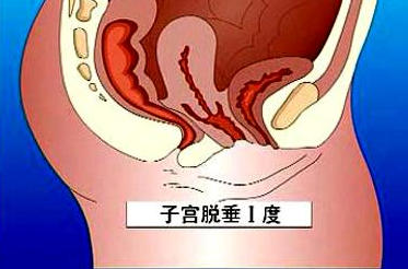 子宮脫垂的症狀腰骶部痠痛