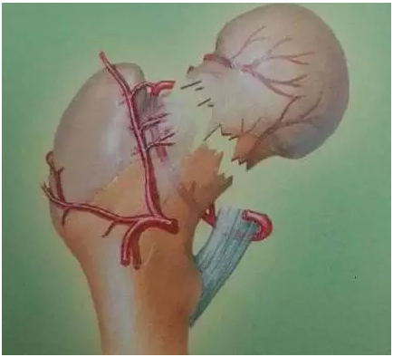 (股骨头坏死病根是血管堵塞)