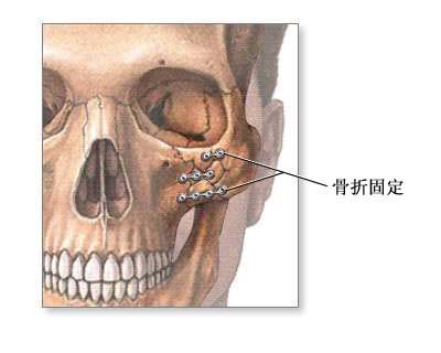 解剖:面部由四塊主要的骨組成:上頷骨,顴骨,下頷骨和頭蓋骨中的額骨