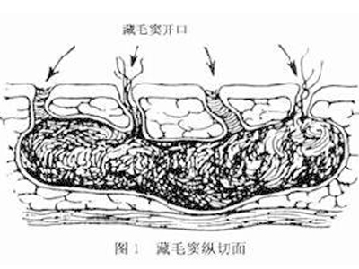 骶尾部藏毛窦图片