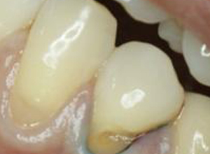铅线牙龈图片