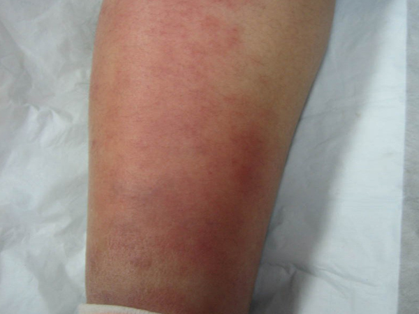 丹毒是皮肤及其网状淋巴管的急性炎症.好发于下肢和面部.
