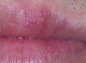 漂唇厌氧菌感染图片图片