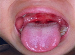 小儿咽峡炎的症状图片图片
