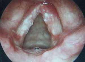 喉白斑病咽炎图片
