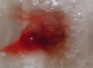 肺癌吐血图片图片