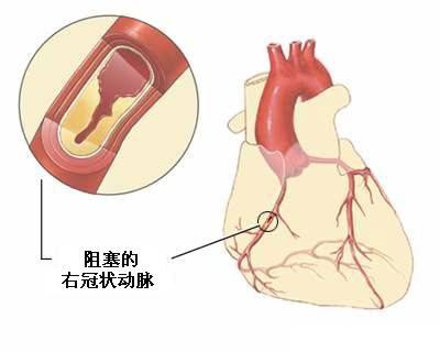 冠状动脉球囊扩张图片