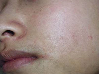 面颈毛囊性红斑黑变病图片