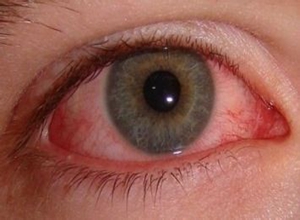 虹膜炎症状 早期症状图片