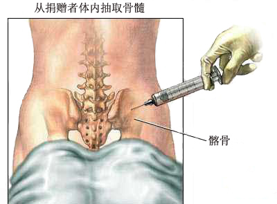 移植骨髓由静脉注入病人体内后,会自然进入骨髓腔里,在那里快速生长