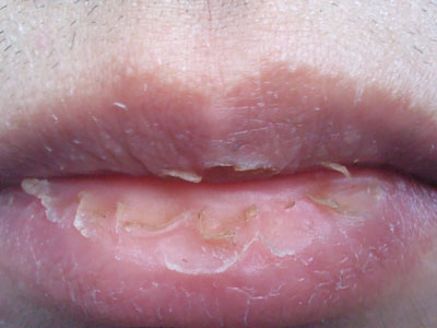 真菌性唇炎症状图片