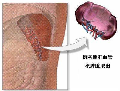对于儿童,如果是外伤导致的脾脏破裂,则将切除的脾脏切成小薄片,重新