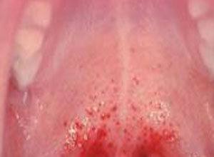 颚部出现小出血点多提示为扁桃体炎,扁桃体炎是扁桃体的炎症