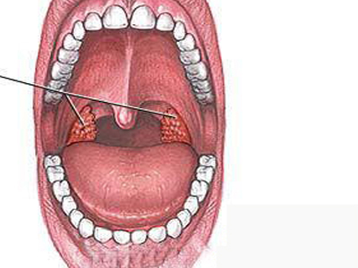 为咽部淋巴组织的异常角化,多发生于腭扁桃体和舌扁桃体