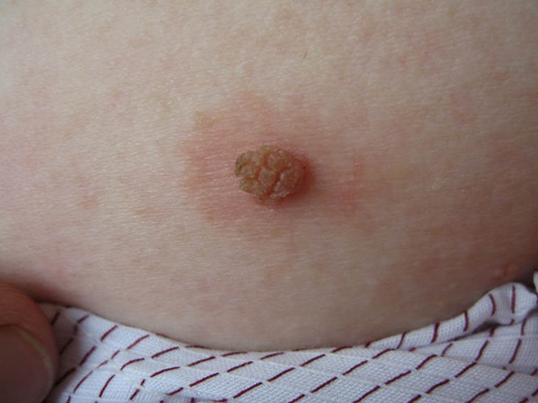 一般表现:病变初期,表现为硬固,突出皮面的小丘疹,呈灰黄灰白,黄褐或