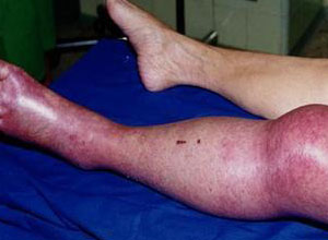 下肢脉管炎 症状图片