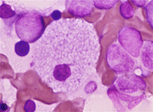 尼曼匹克细胞染色图片